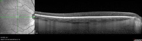 Oculocutaneous albinism
62 year old female.  Testing shows an absence of a fovea.  Vision was 20/50 and she has nystagmus.
