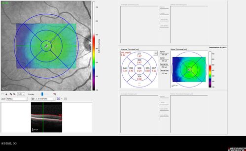 Oculocutaneous albinism
62 year old female.  Testing shows an absence of a fovea.  Vision was 20/50 and she has nystagmus.
