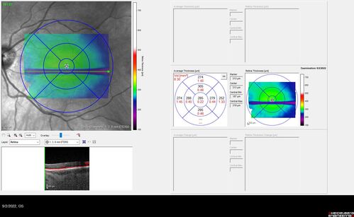 Oculocutaneous albinism
62 year old female.  Testing shows an absence of a fovea.  Vision was 20/50 and she has nystagmus.
