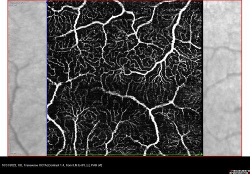 Oculocutaneous albinism
62 year old female.  Testing shows an absence of a fovea.  Vision was 20/50 and she has nystagmus.
