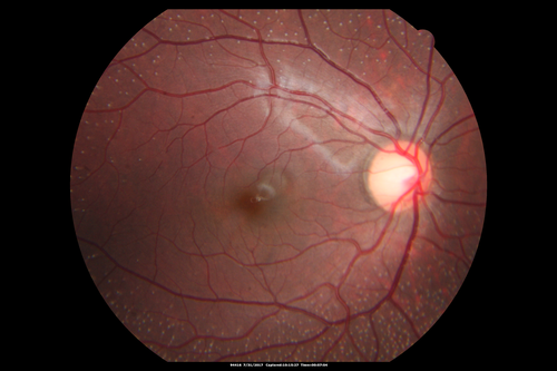 Fundus Albipunctatus
12 year old female with normal vision.  She has 4 siblings all of whom have either white spots or spots on IR.  Genetic testing by parents was deferred.
