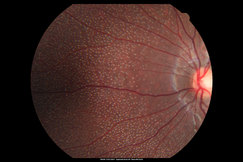 Fundus Albipunctatus
12 year old female with normal vision.  She has 4 siblings all of whom have either white spots or spots on IR.  Genetic testing by parents was deferred.
