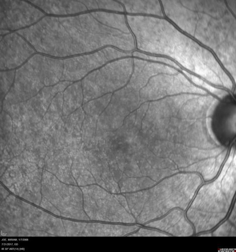 Fundus Albipunctatus
12 year old female with normal vision.  She has 4 siblings all of whom have either white spots or spots on IR.  Genetic testing by parents was deferred.
