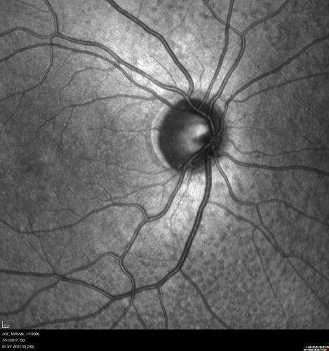 Fundus Albipunctatus
12 year old female with normal vision.  She has 4 siblings all of whom have either white spots or spots on IR.  Genetic testing by parents was deferred.
