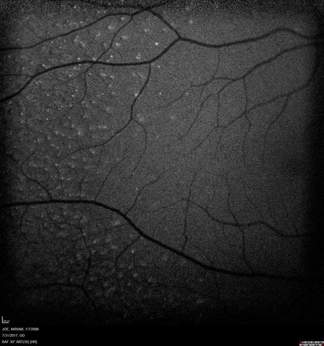 Fundus Albipunctatus
12 year old female with normal vision.  She has 4 siblings all of whom have either white spots or spots on IR.  Genetic testing by parents was deferred.
