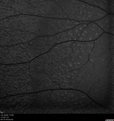 Fundus Albipunctatus
12 year old female with normal vision.  She has 4 siblings all of whom have either white spots or spots on IR.  Genetic testing by parents was deferred.
