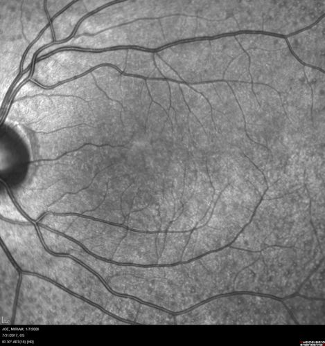 Fundus Albipunctatus
12 year old female with normal vision.  She has 4 siblings all of whom have either white spots or spots on IR.  Genetic testing by parents was deferred.
