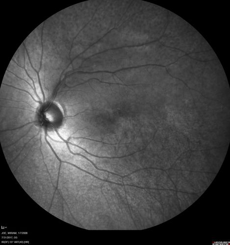 Fundus Albipunctatus
12 year old female with normal vision.  She has 4 siblings all of whom have either white spots or spots on IR.  Genetic testing by parents was deferred.
