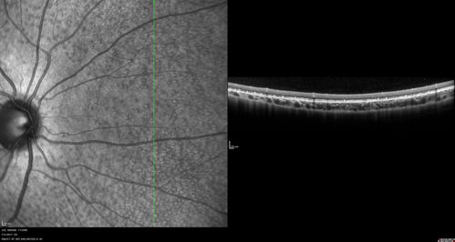 Fundus Albipunctatus
12 year old female with normal vision.  She has 4 siblings all of whom have either white spots or spots on IR.  Genetic testing by parents was deferred.
