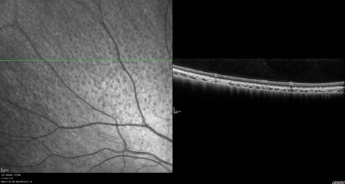 Fundus Albipunctatus
12 year old female with normal vision.  She has 4 siblings all of whom have either white spots or spots on IR.  Genetic testing by parents was deferred.
