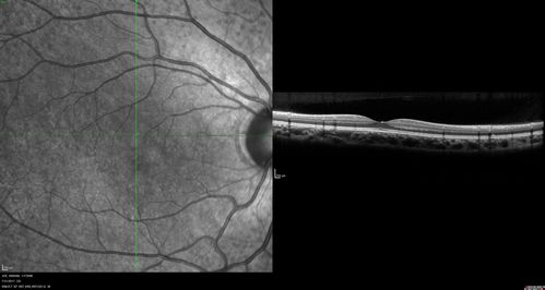 Fundus Albipunctatus
12 year old female with normal vision.  She has 4 siblings all of whom have either white spots or spots on IR.  Genetic testing by parents was deferred.
