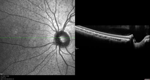 Fundus Albipunctatus
12 year old female with normal vision.  She has 4 siblings all of whom have either white spots or spots on IR.  Genetic testing by parents was deferred.
