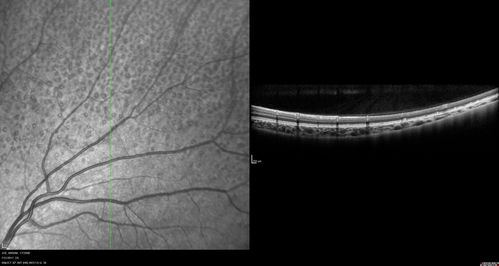 Fundus Albipunctatus
12 year old female with normal vision.  She has 4 siblings all of whom have either white spots or spots on IR.  Genetic testing by parents was deferred.
