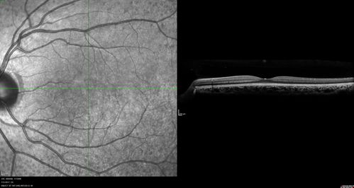 Fundus Albipunctatus
12 year old female with normal vision.  She has 4 siblings all of whom have either white spots or spots on IR.  Genetic testing by parents was deferred.
