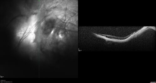 Staphyloma and Atrophy with Vitreoretinal traction
Only eye of patient with Albinism and decreasing vision now 5/200 in this 72 year old man.  There is myopic tractional maculopathy.  The patient also has albinism by history.
