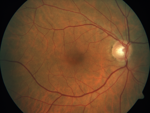 Normal Right eye
67 year old female with CSR in the left eye first 20 years ago.  She was managed with out therapy and has had a few episodes since.  Now ther eis distortion in the left eye for a few days.  She had a steroid shot in her shoulder 5 months ago.
VA 20/20 OD, 20/50 OS
