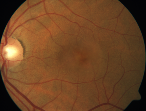 Choroidal Neovascular Membrane following Prior Central Serous Chorioretinopathy - OCT-A
67 year old female with CSR in the left eye first 20 years ago.  She was managed with out therapy and has had a few episodes since.  Now ther eis distortion in the left eye for a few days.  She had a steroid shot in her shoulder 5 months ago.
VA 20/20 OD, 20/50 OS- ICG and OCT-A confirm CNVM in the left eye

