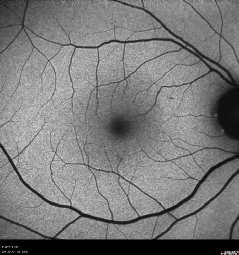 Choroidal Neovascular Membrane following Prior Central Serous Chorioretinopathy - OCT-A
67 year old female with CSR in the left eye first 20 years ago.  She was managed with out therapy and has had a few episodes since.  Now ther eis distortion in the left eye for a few days.  She had a steroid shot in her shoulder 5 months ago.
VA 20/20 OD, 20/50 OS- ICG and OCT-A confirm CNVM in the left eye
