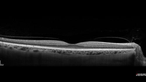 Choroidal Neovascular Membrane following Prior Central Serous Chorioretinopathy - OCT-A
67 year old female with CSR in the left eye first 20 years ago.  She was managed with out therapy and has had a few episodes since.  Now ther eis distortion in the left eye for a few days.  She had a steroid shot in her shoulder 5 months ago.
VA 20/20 OD, 20/50 OS- ICG and OCT-A confirm CNVM in the left eye

