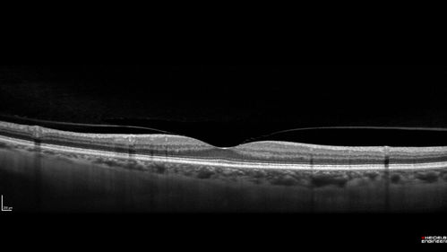 Choroidal Neovascular Membrane following Prior Central Serous Chorioretinopathy - OCT-A
67 year old female with CSR in the left eye first 20 years ago.  She was managed with out therapy and has had a few episodes since.  Now ther eis distortion in the left eye for a few days.  She had a steroid shot in her shoulder 5 months ago.
VA 20/20 OD, 20/50 OS- ICG and OCT-A confirm CNVM in the left eye
