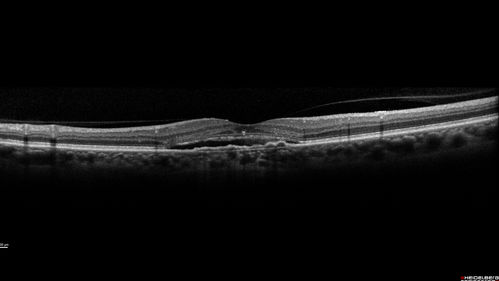 Choroidal Neovascular Membrane following Prior Central Serous Chorioretinopathy - OCT-A
67 year old female with CSR in the left eye first 20 years ago.  She was managed with out therapy and has had a few episodes since.  Now ther eis distortion in the left eye for a few days.  She had a steroid shot in her shoulder 5 months ago.
VA 20/20 OD, 20/50 OS- ICG and OCT-A confirm CNVM in the left eye
