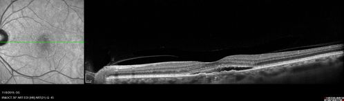 Choroidal Neovascular Membrane following Prior Central Serous Chorioretinopathy - OCT-A
67 year old female with CSR in the left eye first 20 years ago.  She was managed with out therapy and has had a few episodes since.  Now ther eis distortion in the left eye for a few days.  She had a steroid shot in her shoulder 5 months ago.
VA 20/20 OD, 20/50 OS- ICG and OCT-A confirm CNVM in the left eye
