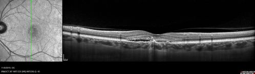 Choroidal Neovascular Membrane following Prior Central Serous Chorioretinopathy - OCT-A
67 year old female with CSR in the left eye first 20 years ago.  She was managed with out therapy and has had a few episodes since.  Now ther eis distortion in the left eye for a few days.  She had a steroid shot in her shoulder 5 months ago.
VA 20/20 OD, 20/50 OS- ICG and OCT-A confirm CNVM in the left eye
