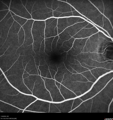 Choroidal Neovascular Membrane following Prior Central Serous Chorioretinopathy - OCT-A
67 year old female with CSR in the left eye first 20 years ago.  She was managed with out therapy and has had a few episodes since.  Now ther eis distortion in the left eye for a few days.  She had a steroid shot in her shoulder 5 months ago.
VA 20/20 OD, 20/50 OS- ICG and OCT-A confirm CNVM in the left eye
