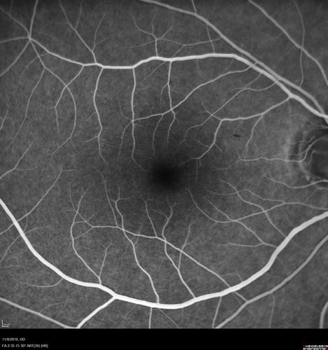 Choroidal Neovascular Membrane following Prior Central Serous Chorioretinopathy - OCT-A
67 year old female with CSR in the left eye first 20 years ago.  She was managed with out therapy and has had a few episodes since.  Now ther eis distortion in the left eye for a few days.  She had a steroid shot in her shoulder 5 months ago.
VA 20/20 OD, 20/50 OS- ICG and OCT-A confirm CNVM in the left eye
