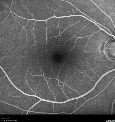 Choroidal Neovascular Membrane following Prior Central Serous Chorioretinopathy - OCT-A
67 year old female with CSR in the left eye first 20 years ago.  She was managed with out therapy and has had a few episodes since.  Now ther eis distortion in the left eye for a few days.  She had a steroid shot in her shoulder 5 months ago.
VA 20/20 OD, 20/50 OS- ICG and OCT-A confirm CNVM in the left eye
