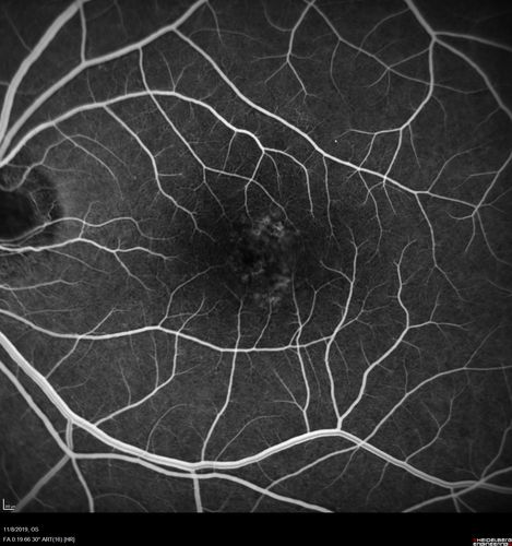Choroidal Neovascular Membrane following Prior Central Serous Chorioretinopathy - OCT-A
67 year old female with CSR in the left eye first 20 years ago.  She was managed with out therapy and has had a few episodes since.  Now ther eis distortion in the left eye for a few days.  She had a steroid shot in her shoulder 5 months ago.
VA 20/20 OD, 20/50 OS- ICG and OCT-A confirm CNVM in the left eye
