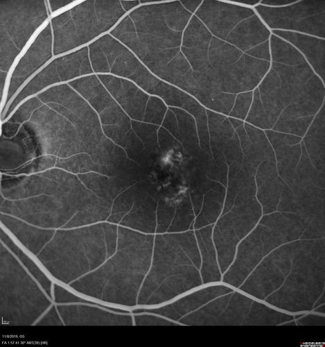 Choroidal Neovascular Membrane following Prior Central Serous Chorioretinopathy - OCT-A
67 year old female with CSR in the left eye first 20 years ago.  She was managed with out therapy and has had a few episodes since.  Now ther eis distortion in the left eye for a few days.  She had a steroid shot in her shoulder 5 months ago.
VA 20/20 OD, 20/50 OS- ICG and OCT-A confirm CNVM in the left eye
