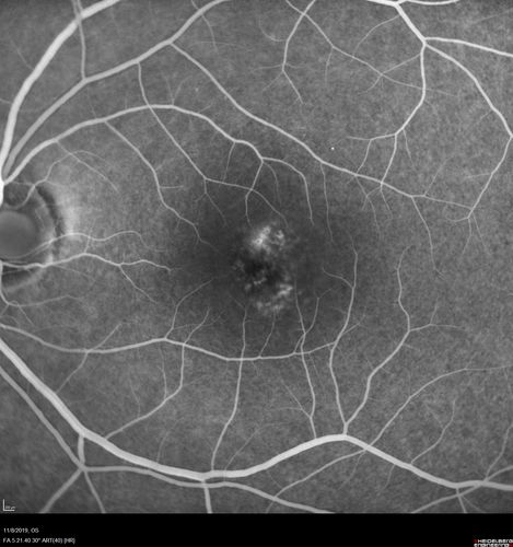 Choroidal Neovascular Membrane following Prior Central Serous Chorioretinopathy - OCT-A
67 year old female with CSR in the left eye first 20 years ago.  She was managed with out therapy and has had a few episodes since.  Now ther eis distortion in the left eye for a few days.  She had a steroid shot in her shoulder 5 months ago.
VA 20/20 OD, 20/50 OS- ICG and OCT-A confirm CNVM in the left eye
