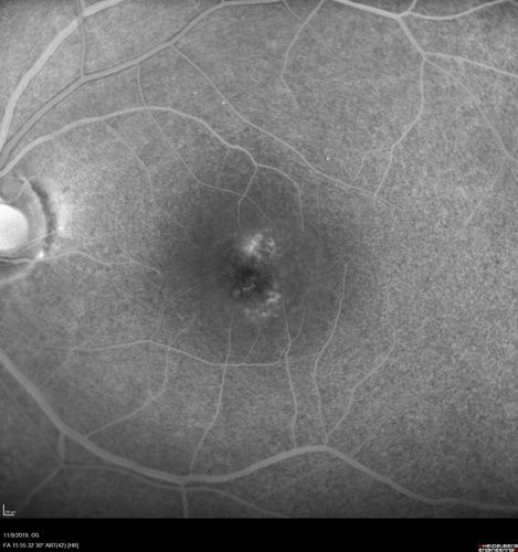 Choroidal Neovascular Membrane following Prior Central Serous Chorioretinopathy - OCT-A
67 year old female with CSR in the left eye first 20 years ago.  She was managed with out therapy and has had a few episodes since.  Now ther eis distortion in the left eye for a few days.  She had a steroid shot in her shoulder 5 months ago.
VA 20/20 OD, 20/50 OS- ICG and OCT-A confirm CNVM in the left eye
