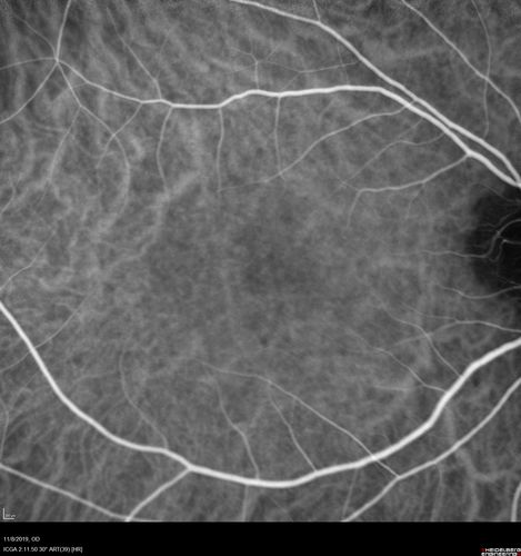 Choroidal Neovascular Membrane following Prior Central Serous Chorioretinopathy - OCT-A
67 year old female with CSR in the left eye first 20 years ago.  She was managed with out therapy and has had a few episodes since.  Now ther eis distortion in the left eye for a few days.  She had a steroid shot in her shoulder 5 months ago.
VA 20/20 OD, 20/50 OS- ICG and OCT-A confirm CNVM in the left eye
