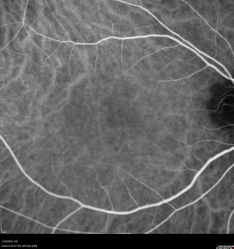 Choroidal Neovascular Membrane following Prior Central Serous Chorioretinopathy - OCT-A
67 year old female with CSR in the left eye first 20 years ago.  She was managed with out therapy and has had a few episodes since.  Now ther eis distortion in the left eye for a few days.  She had a steroid shot in her shoulder 5 months ago.
VA 20/20 OD, 20/50 OS- ICG and OCT-A confirm CNVM in the left eye
