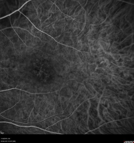 Choroidal Neovascular Membrane following Prior Central Serous Chorioretinopathy - OCT-A
67 year old female with CSR in the left eye first 20 years ago.  She was managed with out therapy and has had a few episodes since.  Now ther eis distortion in the left eye for a few days.  She had a steroid shot in her shoulder 5 months ago.
VA 20/20 OD, 20/50 OS- ICG and OCT-A confirm CNVM in the left eye
