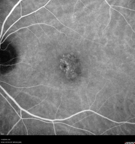Choroidal Neovascular Membrane following Prior Central Serous Chorioretinopathy - OCT-A
67 year old female with CSR in the left eye first 20 years ago.  She was managed with out therapy and has had a few episodes since.  Now ther eis distortion in the left eye for a few days.  She had a steroid shot in her shoulder 5 months ago.
VA 20/20 OD, 20/50 OS- ICG and OCT-A confirm CNVM in the left eye
