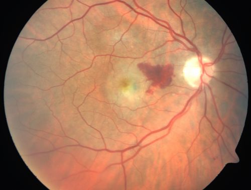 Cartwheel CNVM - Classic - wet AMD - evidence of possible old CSR -  Subretinal hemorrhage next to subfoveal lesion
75 y.o Decreased Vision right eye for one year.   VA OD: sc20/125+2 OS 20/25.  Autofluorescence and SD OCT show evidence of old serous retinal detachment superior to the fovea suggesting a history of CSR.  The macular lesion on FA shows a classic cartwheel appearance
