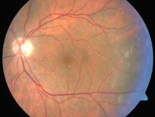 Cartwheel CNVM - Classic - wet AMD - evidence of possible old CSR - Fellow eye has hydrophilic Drusen
75 y.o Decreased Vision right eye for one year.   VA OD: sc20/125+2 OS 20/25.  Autofluorescence and SD OCT show evidence of old serous retinal detachment superior to the fovea suggesting a history of CSR.  The macular lesion on FA shows a classic cartwheel appearance
