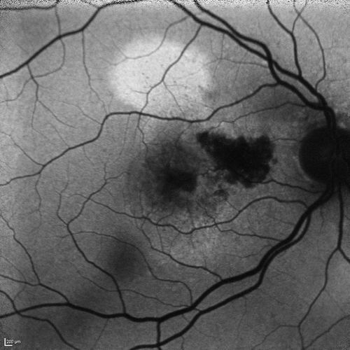Cartwheel CNVM - Classic - wet AMD - evidence of possible old CSR - Autofluorescence shows brigh spot superior to subfoveal lesion
75 y.o Decreased Vision right eye for one year.   VA OD: sc20/125+2 OS 20/25.  Autofluorescence and SD OCT show evidence of old serous retinal detachment superior to the fovea suggesting a history of CSR.  The macular lesion on FA shows a classic cartwheel appearance
