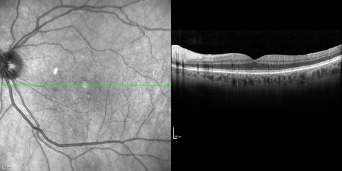Cartwheel CNVM - Classic - wet AMD - evidence of possible old CSR
75 y.o Decreased Vision right eye for one year.   VA OD: sc20/125+2 OS 20/25.  Autofluorescence and SD OCT show evidence of old serous retinal detachment superior to the fovea suggesting a history of CSR.  The macular lesion on FA shows a classic cartwheel appearance
