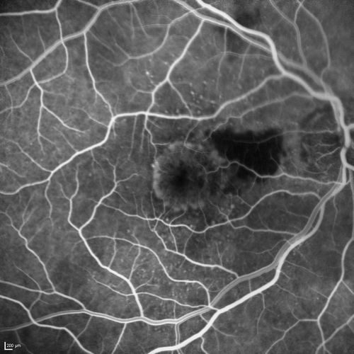 Cartwheel CNVM - Classic - wet AMD - evidence of possible old CSR - FA shows cartwheel shaped CNVM
75 y.o Decreased Vision right eye for one year.   VA OD: sc20/125+2 OS 20/25.  Autofluorescence and SD OCT show evidence of old serous retinal detachment superior to the fovea suggesting a history of CSR.  The macular lesion on FA shows a classic cartwheel appearance
