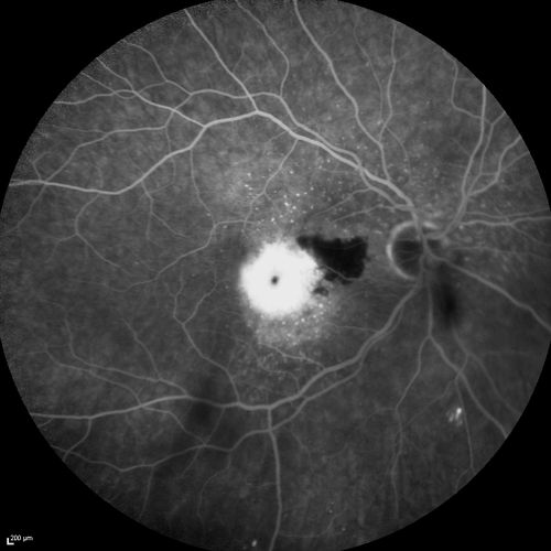 Cartwheel CNVM - Classic - wet AMD - evidence of possible old CSR - FA shows cartwheel shaped CNVM
75 y.o Decreased Vision right eye for one year.   VA OD: sc20/125+2 OS 20/25.  Autofluorescence and SD OCT show evidence of old serous retinal detachment superior to the fovea suggesting a history of CSR.  The macular lesion on FA shows a classic cartwheel appearance
