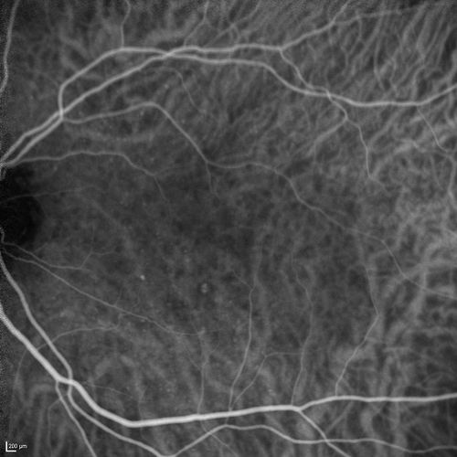 Cartwheel CNVM - Classic - wet AMD - evidence of possible old CSR - ICG is normal - shows nothing
75 y.o Decreased Vision right eye for one year.   VA OD: sc20/125+2 OS 20/25.  Autofluorescence and SD OCT show evidence of old serous retinal detachment superior to the fovea suggesting a history of CSR.  The macular lesion on FA shows a classic cartwheel appearance
