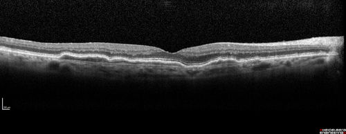 Asymptomatic wet AMD - Subfoveal CNM both eyes
82 year old woman - 20/25 OU. Images show occult subfoveal CNVM both eyes best seen on late ICG.  The left eye also has probable polypoidal choroidal vasculopathy.  No treatment was recommended on the first visit - follow-up at 1 month.
