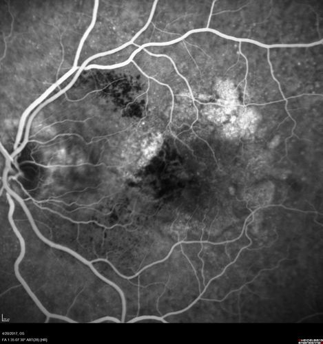 Asymptomatic wet AMD - Subfoveal CNM both eyes
82 year old woman - 20/25 OU. Images show occult subfoveal CNVM both eyes best seen on late ICG.  The left eye also has probable polypoidal choroidal vasculopathy.  No treatment was recommended on the first visit - follow-up at 1 month.
