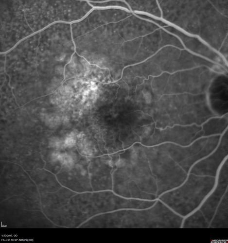 Asymptomatic wet AMD - Subfoveal CNM both eyes
82 year old woman - 20/25 OU. Images show occult subfoveal CNVM both eyes best seen on late ICG.  The left eye also has probable polypoidal choroidal vasculopathy.  No treatment was recommended on the first visit - follow-up at 1 month.
