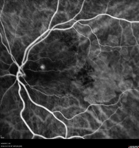Asymptomatic wet AMD - Subfoveal CNM both eyes
82 year old woman - 20/25 OU. Images show occult subfoveal CNVM both eyes best seen on late ICG.  The left eye also has probable polypoidal choroidal vasculopathy.  No treatment was recommended on the first visit - follow-up at 1 month.
