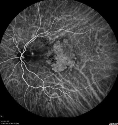 Asymptomatic wet AMD - Subfoveal CNM both eyes
82 year old woman - 20/25 OU. Images show occult subfoveal CNVM both eyes best seen on late ICG.  The left eye also has probable polypoidal choroidal vasculopathy.  No treatment was recommended on the first visit - follow-up at 1 month.
